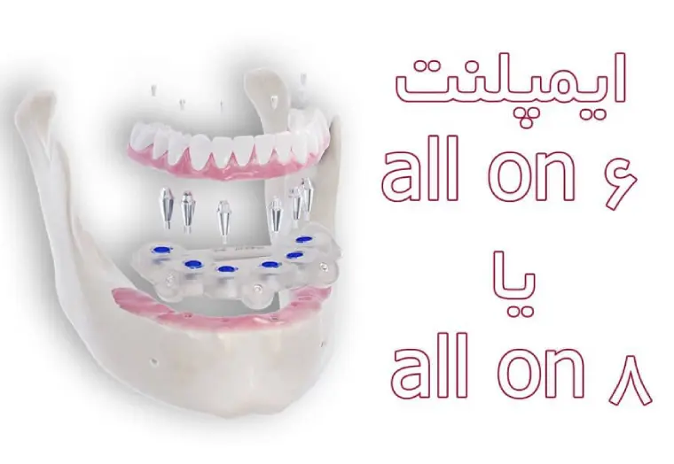 ایمپلنت all on 6 یا all on 8