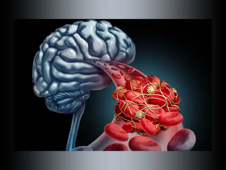 آگاهی از نشانههای سکته مغزی میتواند سلامت شمارا تضمین کند