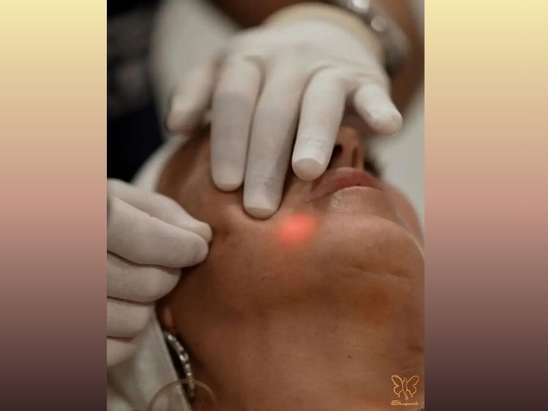 هایفوتراپی پوست صورت