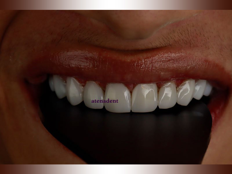مراحل ونیر کامپوزیت دندان
