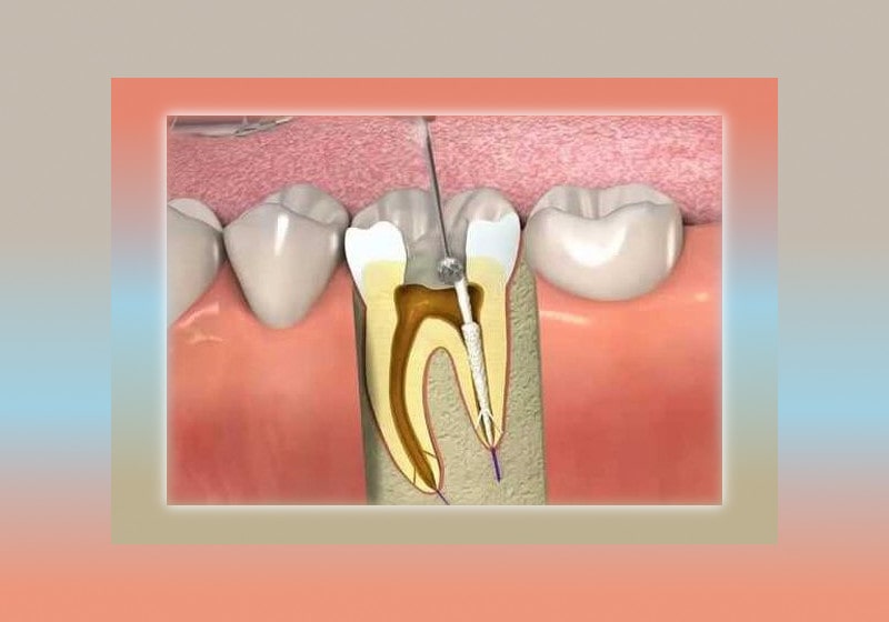عصب کشی دندان