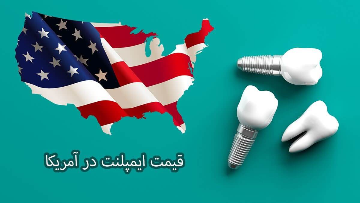 قیمت ایمپلنت در آمریکا