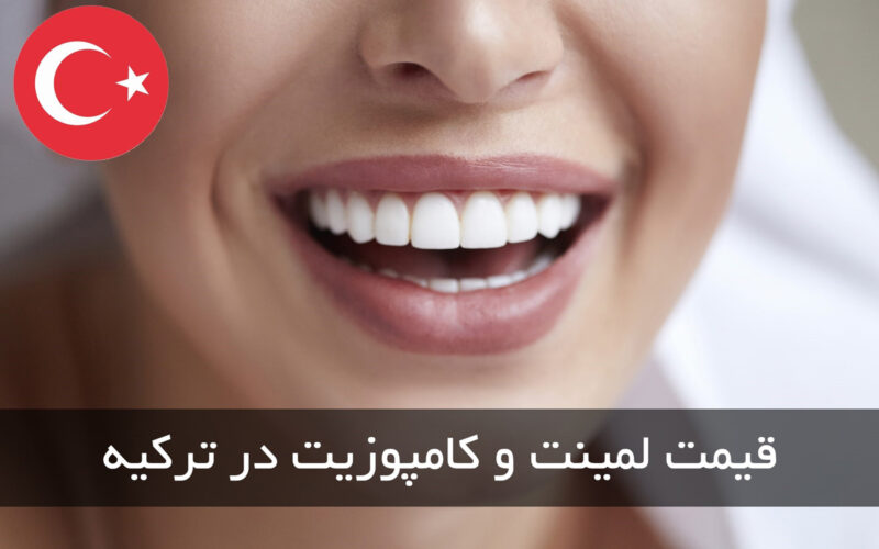 اطلاع از قیمت کامپوزیت دندان در استانبول