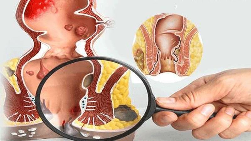 آشنایی با بیماری فیستول مقعدی