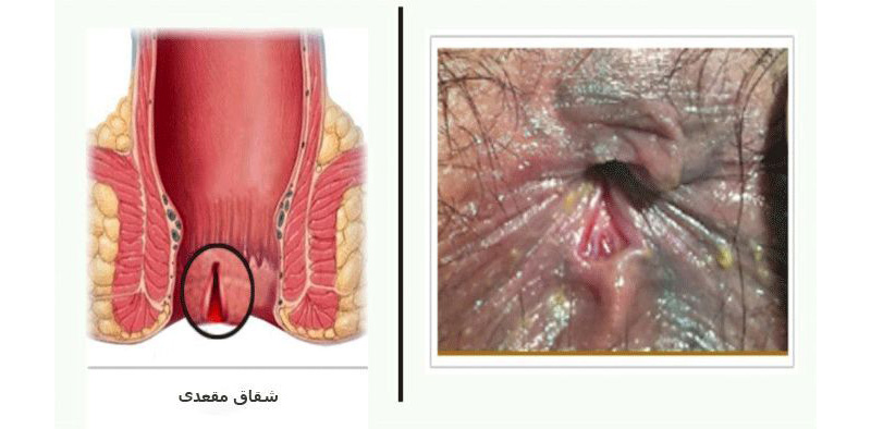 شقاق مقعدی حاد و علائم آن