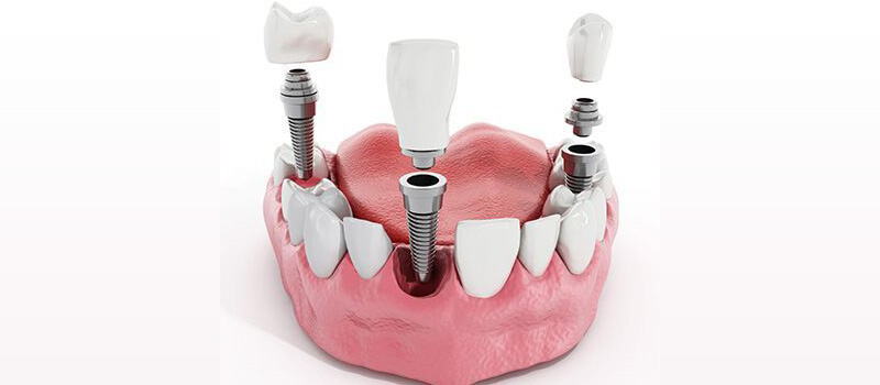 مزایای کامپوزیت و ایمپلنت دندان