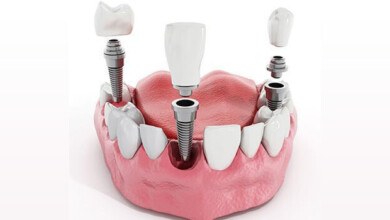 مزایای کامپوزیت و ایمپلنت دندان