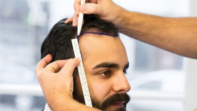 جدیدترین روش کاشت مو