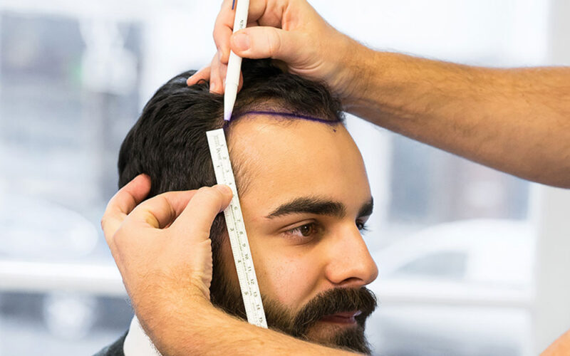 جدیدترین روش کاشت مو