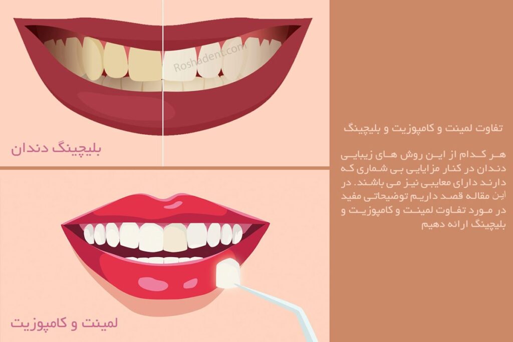 آشنایی با تفاوت لمینت و کامپوزیت و بلیچینگ