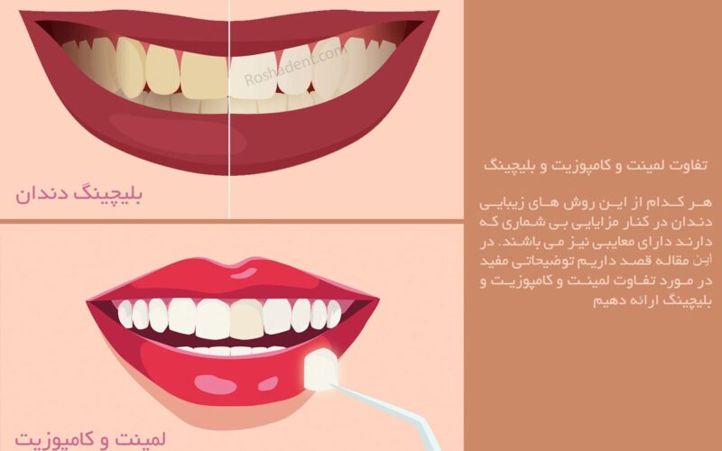 آشنایی با تفاوت لمینت و کامپوزیت و بلیچینگ