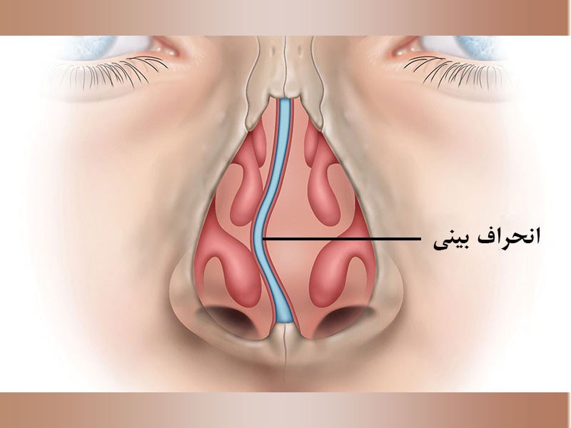 جراحی بینی برای رفع انحراف