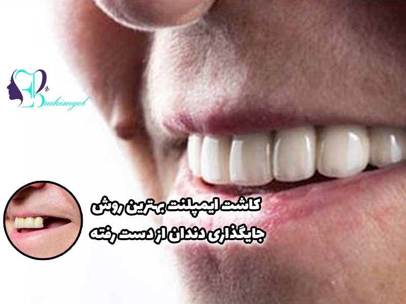 کاشت ایمپلنت فوری روشی برای جایگذاری دندان ها