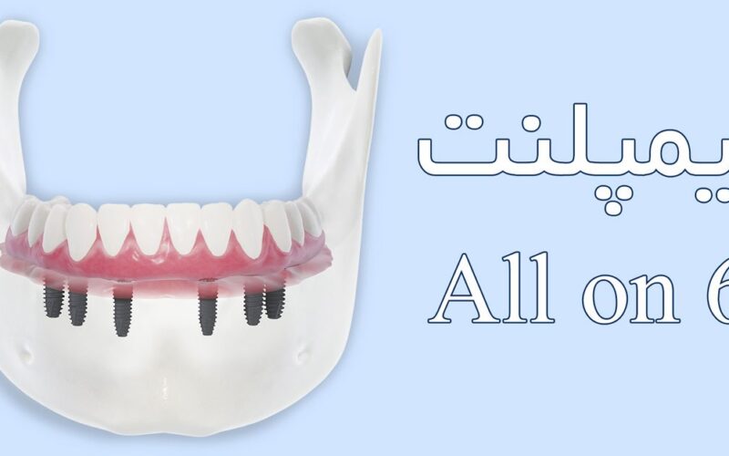 تفاوت ایمپلنت all on 6 و ایمپلنت قدیمی