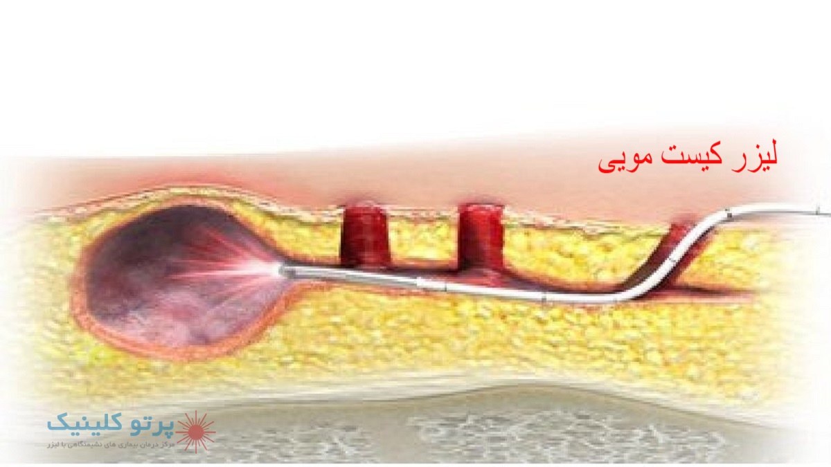 درمان کیست مویی با لیزر