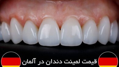 مقایسه قیمت لمینت دندان در آلمان و ایران