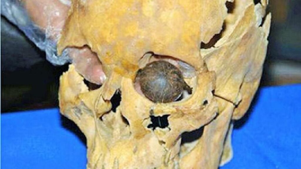 The artificial eye of Shahr-e Sukhte shows advances of Bronze Age medical science