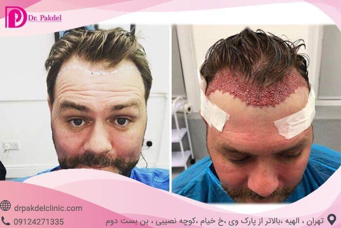 hair transplantation methods complications