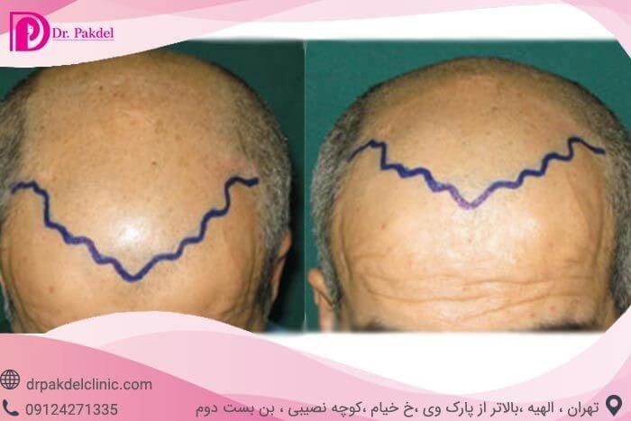 importance of hairline in hair transplantation