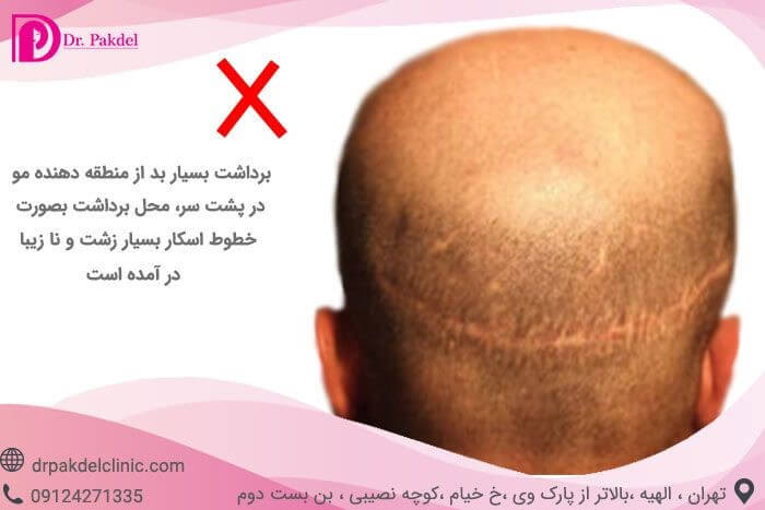 irreversible hair transplantation