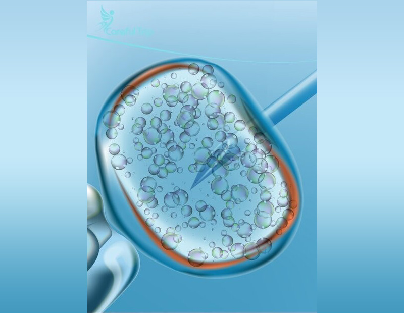 IVF treatment in Iran is provided for various needs