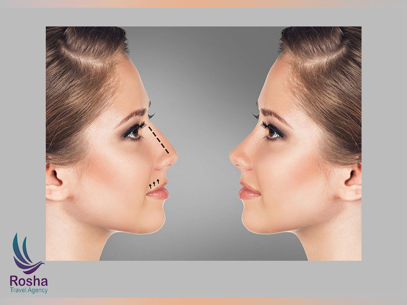 Top Rhinoplasty in Iran