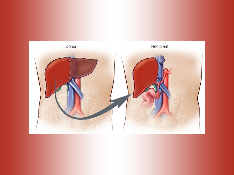 Liver Transplant Takes 2 people: Donor & Recipient