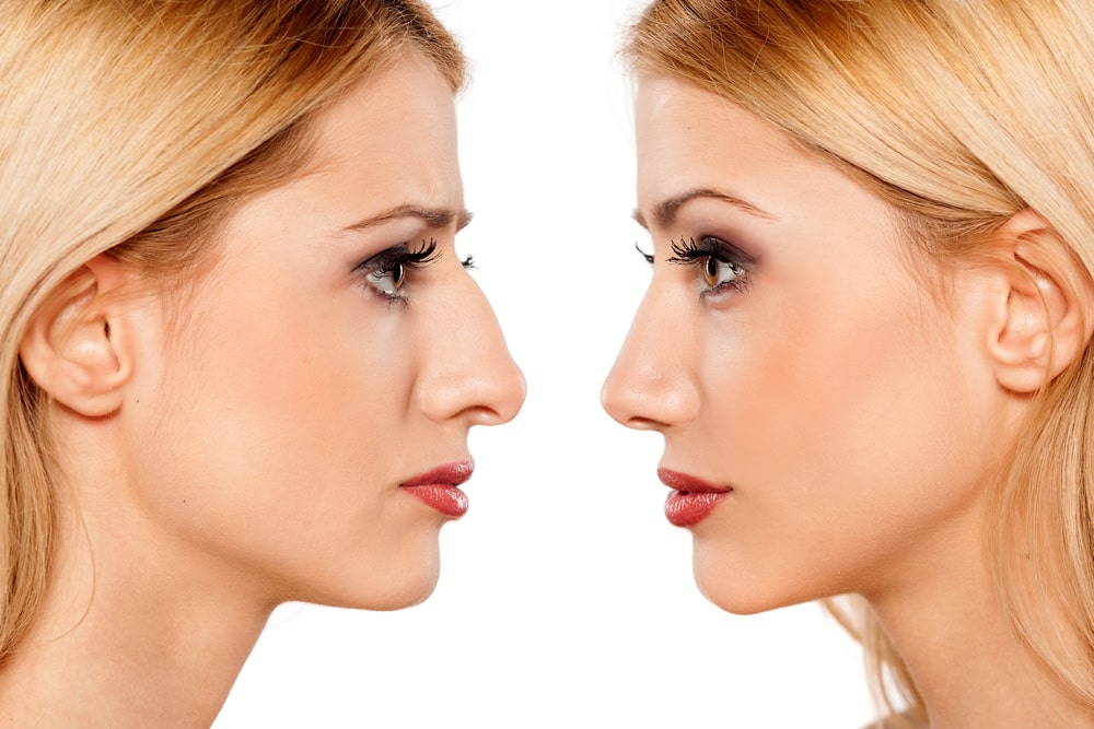 Rhinoplasty, a solution to have a beautiful nose