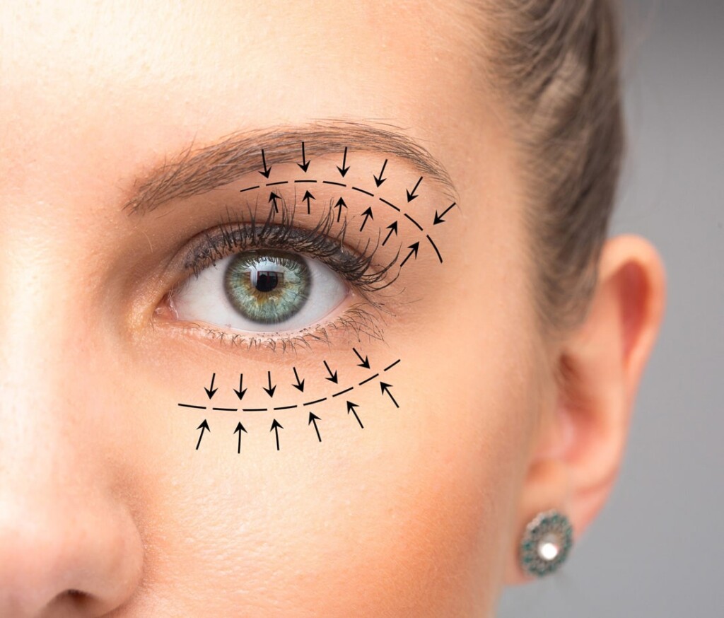 Eyelid surgery with best facilities in Iran